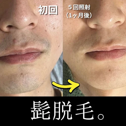 ブラジリアンワックス×光脱毛サロン　MIRUDA【ミルダ】｜Men'sBeauty掲載店舗